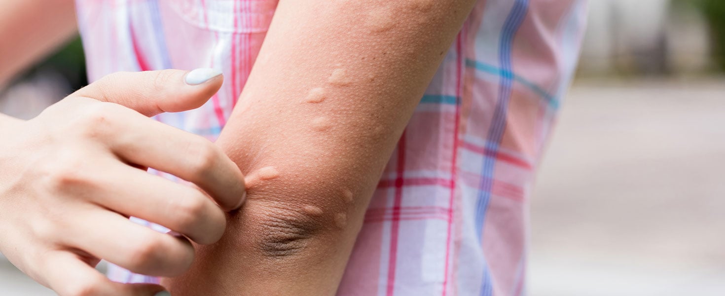 Bug Bites