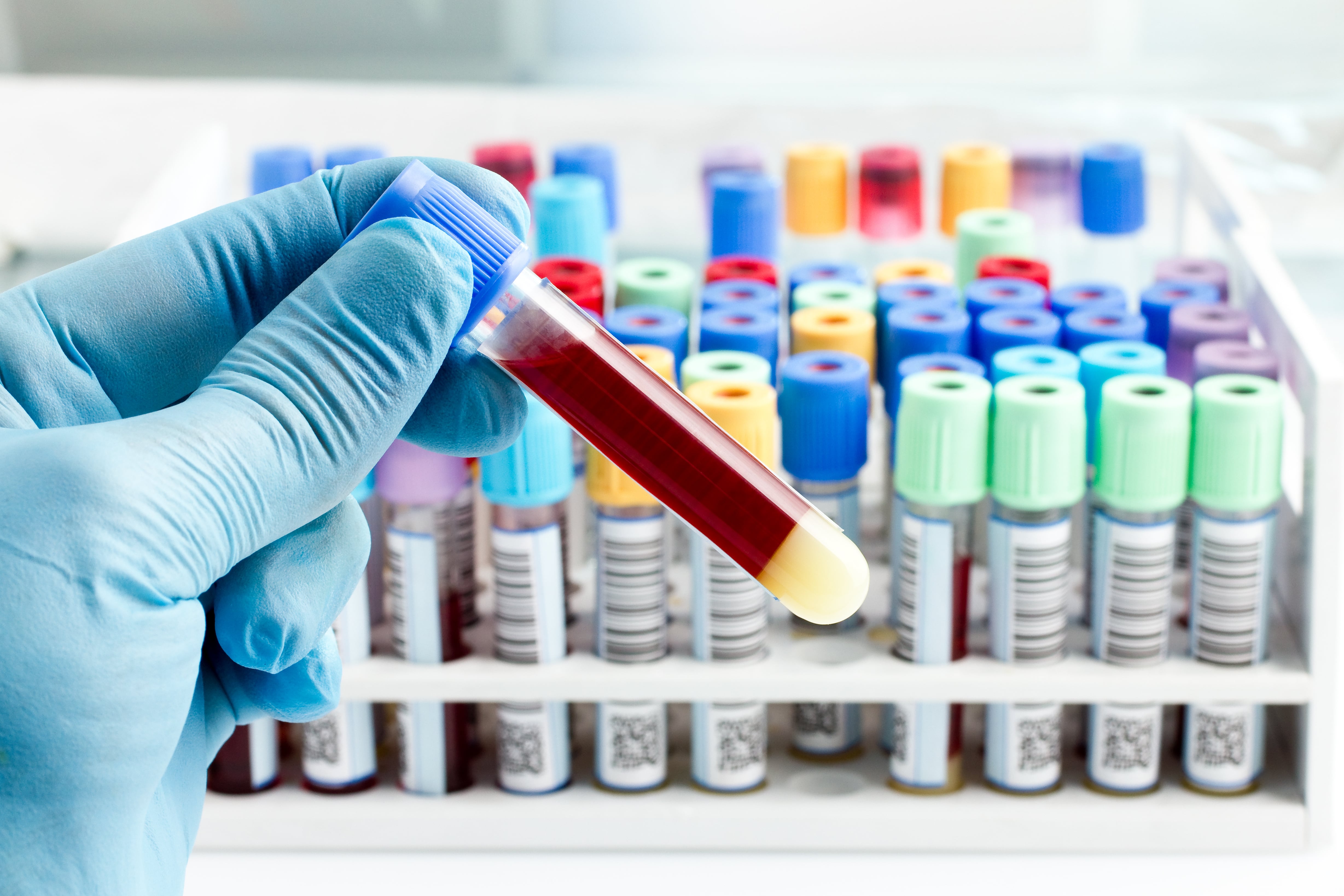 Gloved hand holding a blood sample tube in front of a rack filled with multiple blood collection tubes with colored caps in a laboratory setting.