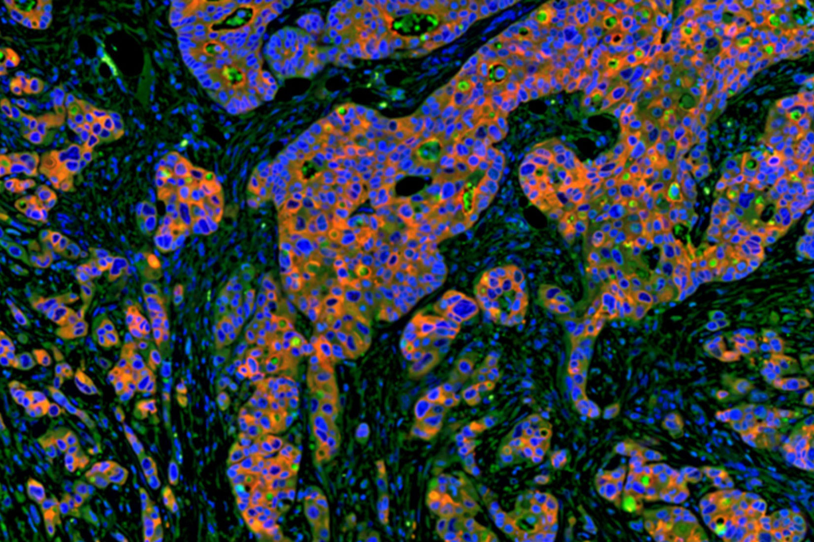 Multicolor immunofluorescence (mIF) for immune cell infiltration