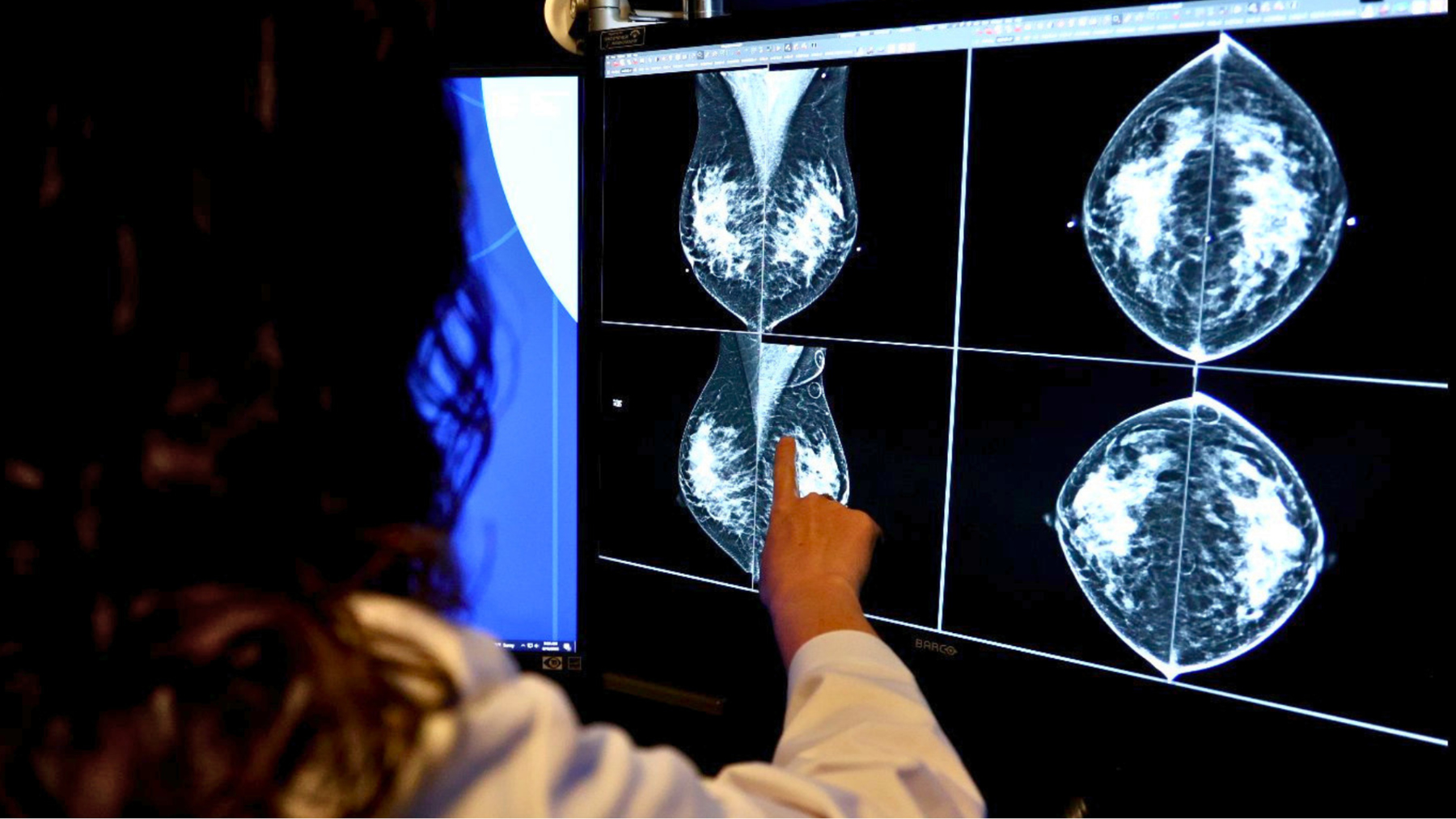 Medical professional pointing at breast imaging scans displayed on a large monitor.