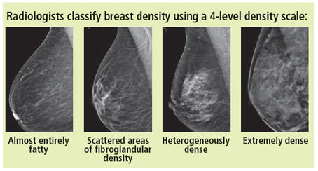 Mammogram images depicting four levels of breast density