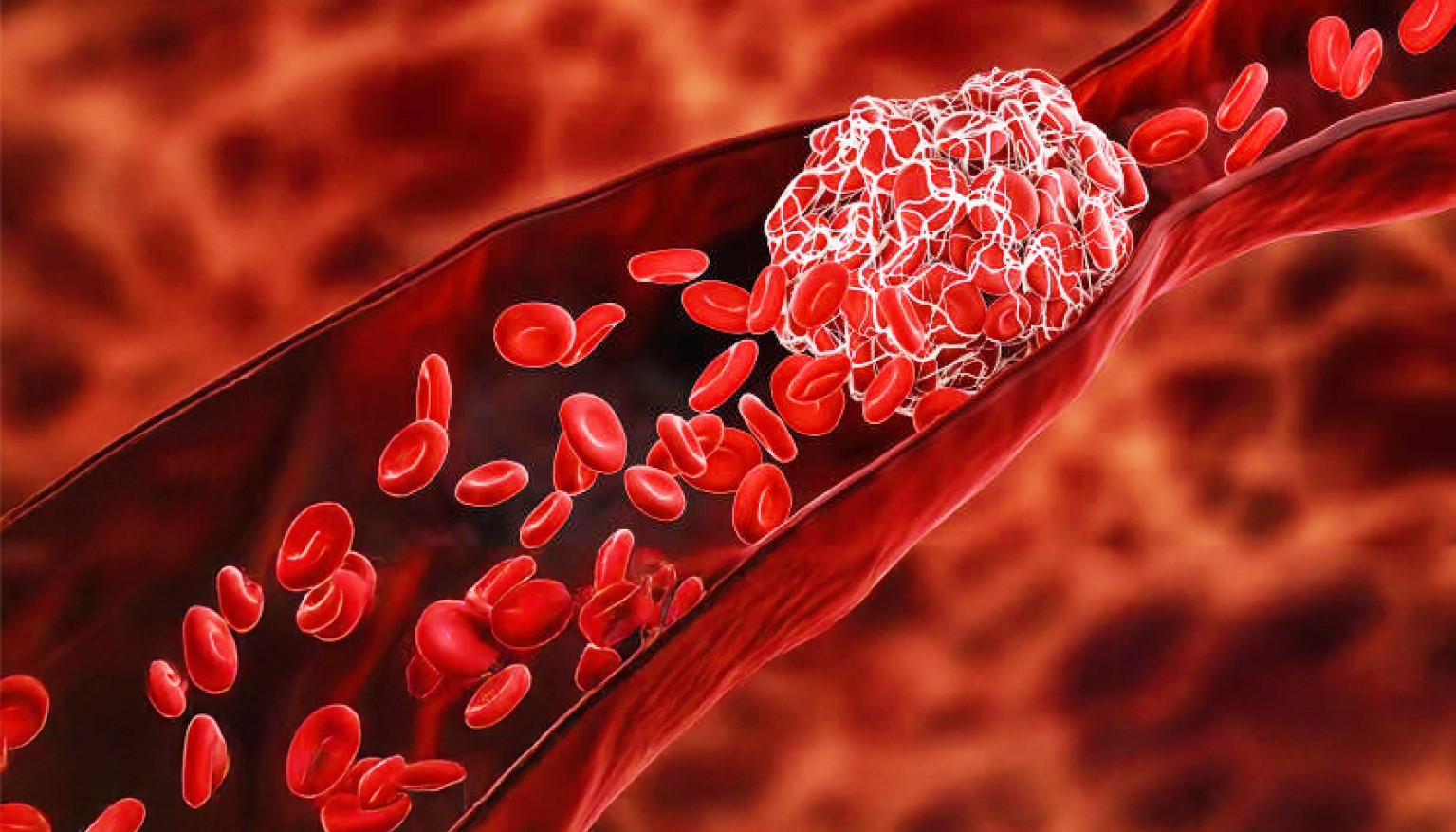 Blood clots_sticky blood cells1