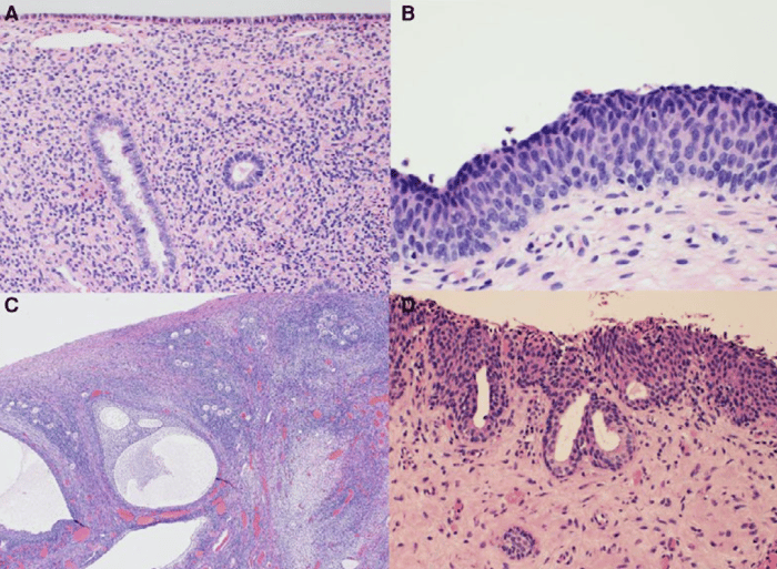 Figure showing histology from hysterectomy and vaginectomy specimens from transgender women on long-term androgen (testosterone) therapy. Key histology features include plump endometrial stromal cells with ample cytoplasm and sparse inactive glands (panel A), ectocervical epithelium resembling urinary bladder epithelium (panel B), ovaries with large cortical follicular cysts and relatively higher number of primordial follicles (panel C), and atrophic vaginal mucosa (panel D).