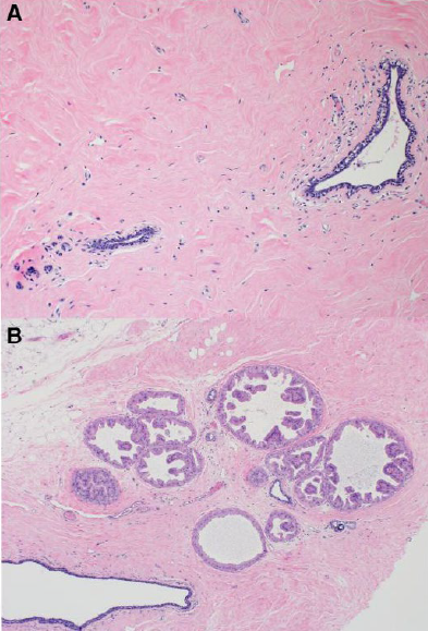 Figure showing histology changes in mastectomy specimens from transgender women on long-term androgen (testosterone) therapy. Key histology features include lobular atrophy with atrophic ductal epithelium and stromal hyalinization/fibrosis (panel A) and fibrocystic changes with apocrine metaplasia and calcification (panel B).