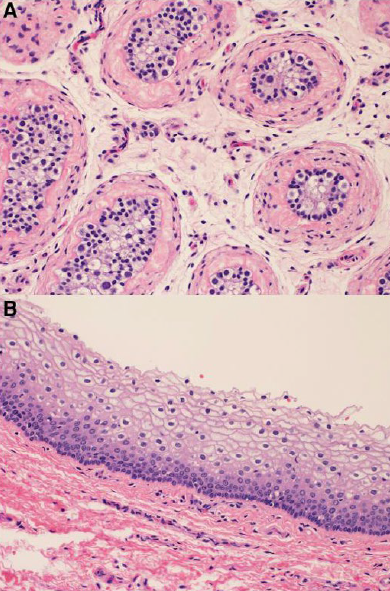 Figure showing histology from orchiectomy and penectomy specimens from transgender men on long-term feminizing therapy (estradiol with or without antiandrogen medication). Key histology features include testicular atrophy with increased stromal/basement membrane fibrosis, reduction of Leydig cell numbers, and Sertoli cell cytoplasmic vacuolization (panel A) and penile urethral epithelium with squamous cell metaplasia (panel B).