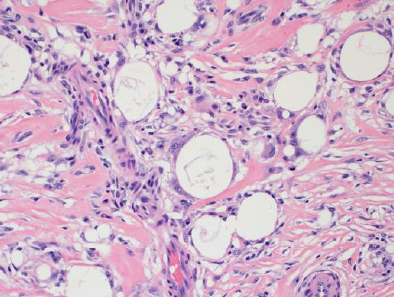 Figure showing an example of histologic changes resulting from a gender-affirming surgery but unrelated to gender-affirming hormone therapy. The image shows histology from a surgical pathology specimen from tissue involved in an augmentation procedure that results in foreign body-type reaction with exogenous foreign material consistent with silicone implant particles associated with multinucleated giant cell reaction, fat necrosis, and stromal fibrosis.