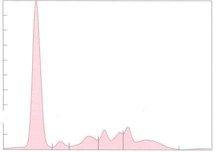 Is There an M-spike in the Globulin Fraction of This Sample?-3