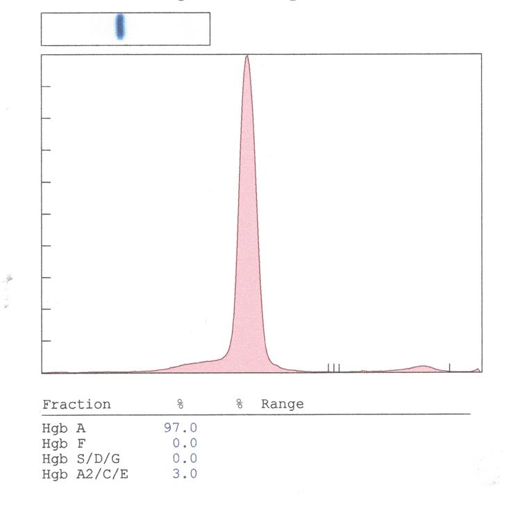 Where Is the Hemoglobin S?
