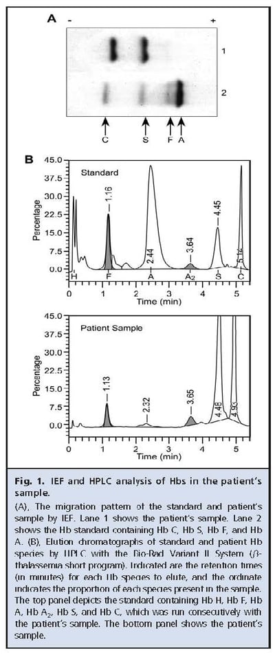 Fig 1 IEF and HPLC analysis of Hbs in the patient's sample