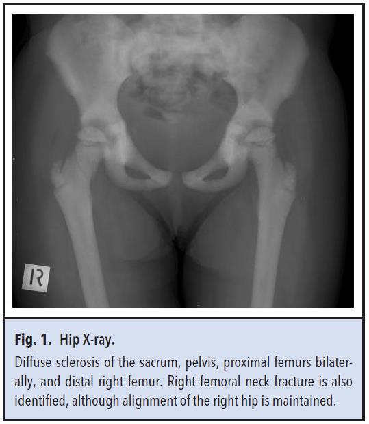 Fig 1. Hip x-ray