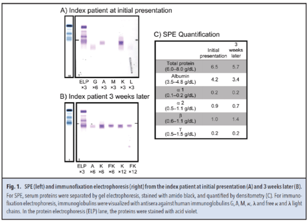 Figure 1. SPE (left) and immunofixation electrophoresis (right) from the index patient at initial presentation (A) and 3 weeks later (B)