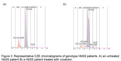 Sickle cell chromatogram