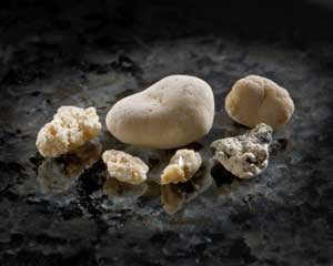 Kidney stones