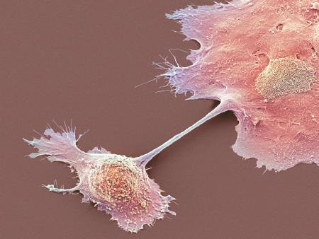 Pancreatic cancer tumor