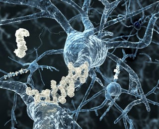 Alzheimer&rsquo;s graphic