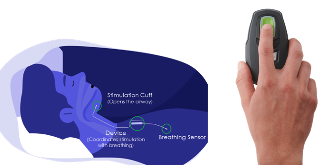 Illustration of how the device works