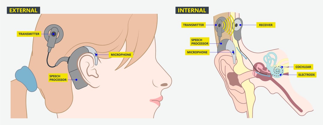 Cochlear Implant diagram