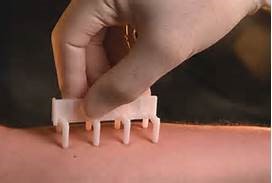 Allergy skin test