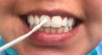 fluoride varnish