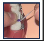 Spacer in tooth