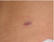 skin lesion 3