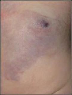 venous malformation