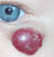 under eye infanile growth