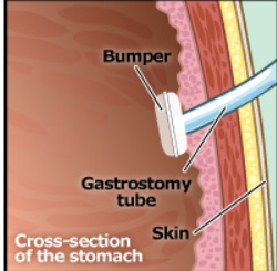 A gastrostomy tube with bumper