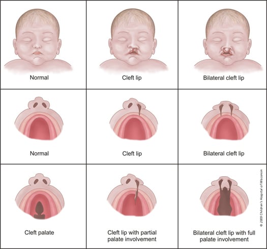 cleft525CR