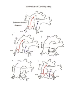 Anomalous Left Coronary Artery illustration