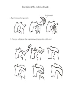 Aortic Coarctation illustration 2