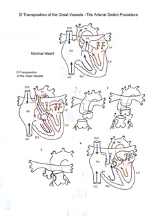 Arterial Switch Procedure illustration