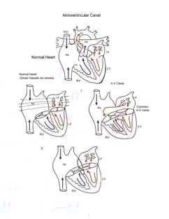 Atrioventricular Canal illustration