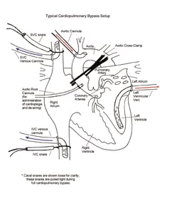 Cardiopulmonary Bypass illustration