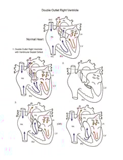 Double Outlet Right Ventricle illustration
