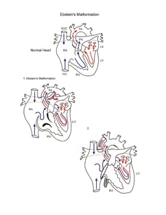 Ebsteins Anomaly illustration
