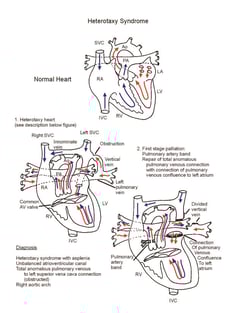 Heterotaxy Syndrome illustration 1