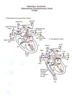Heterotaxy Syndrome illustration 2