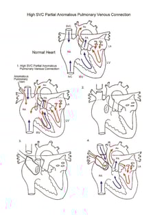 High SVC Partial Anomalous Pulmonary Venous Connection illustration