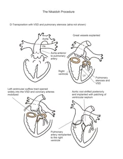 Nikaidoh Procedure illustration