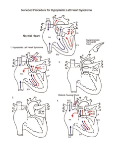 Norwood Procedure illustration 1