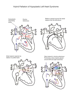 Norwood Procedure illustration 3