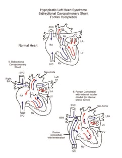 Norwood Procedure illustration 4