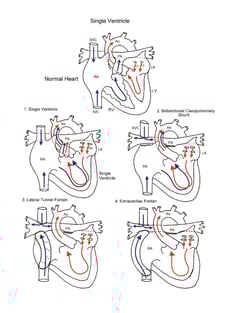 Norwood Procedure illustration 5