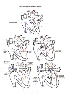 One and a half ventricle repair illustration