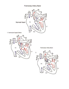 Pulmonary Artery Band illustration