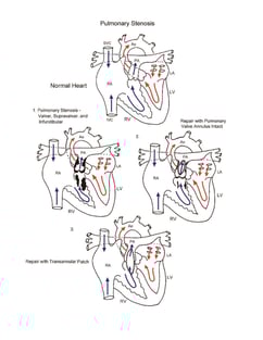 Pulmonary stenosis illustration