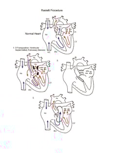Rastelli procedure illustration