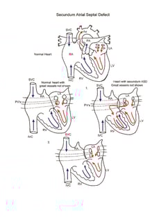 Secundum Atrial Septal Defect illustration
