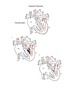 Subaortic Stenosis illustration